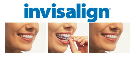 invisalign teeth