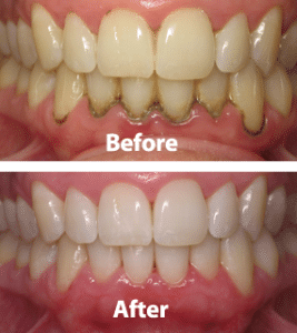 Periodontal-before-after-01