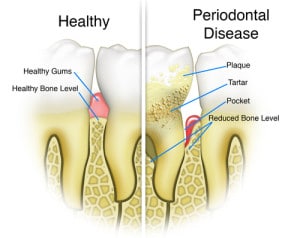 Gum Disease Illustration