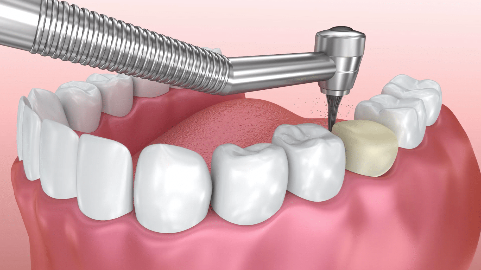 Damaged Tooth Repair: Porcelain Crown
