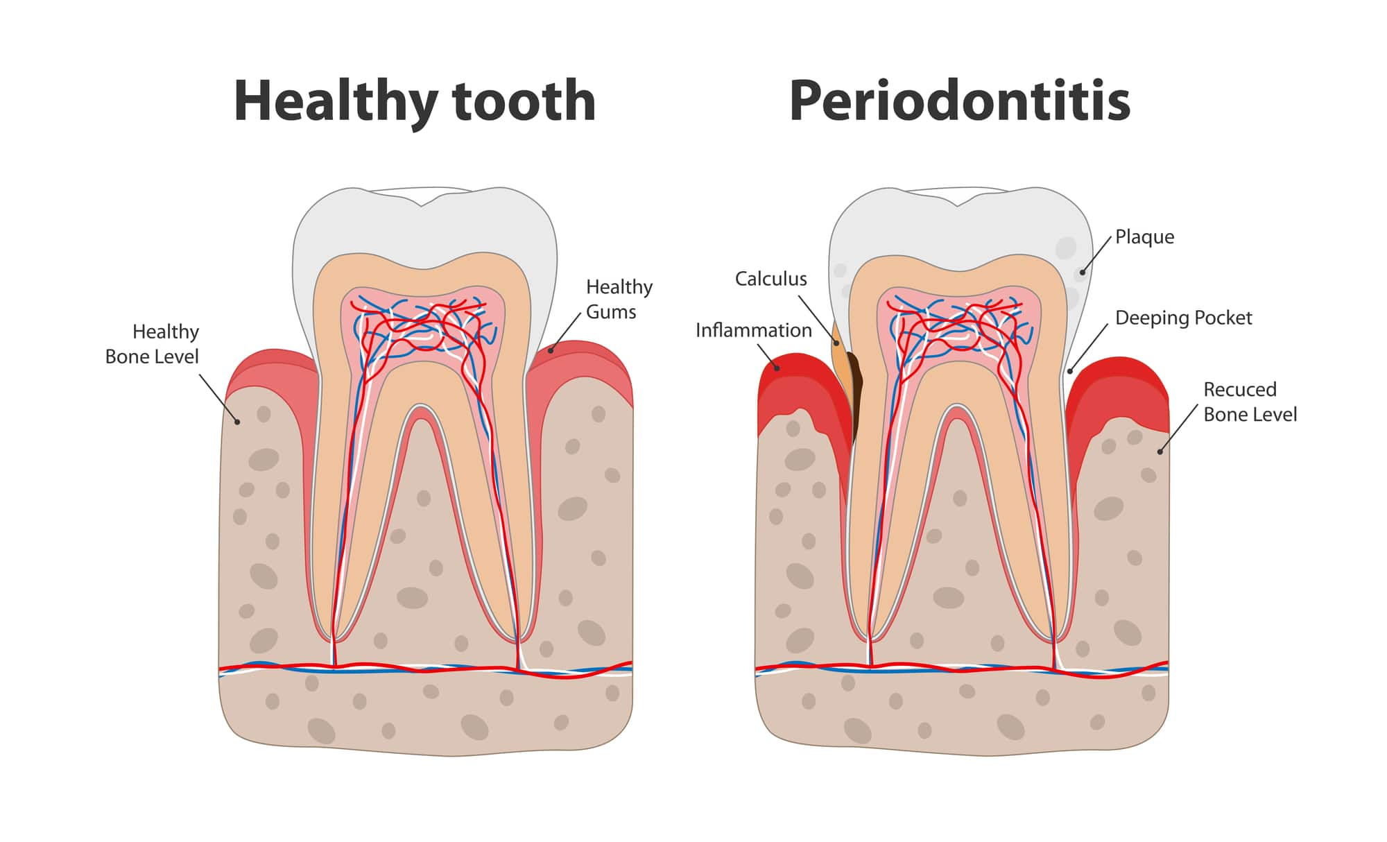 Modern and Effective Periodontal Treatments - Austin Laser Dentist