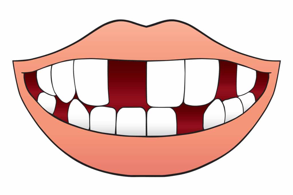 Austin Local Dentist Explains Why Patients Should Replace Missing Teeth