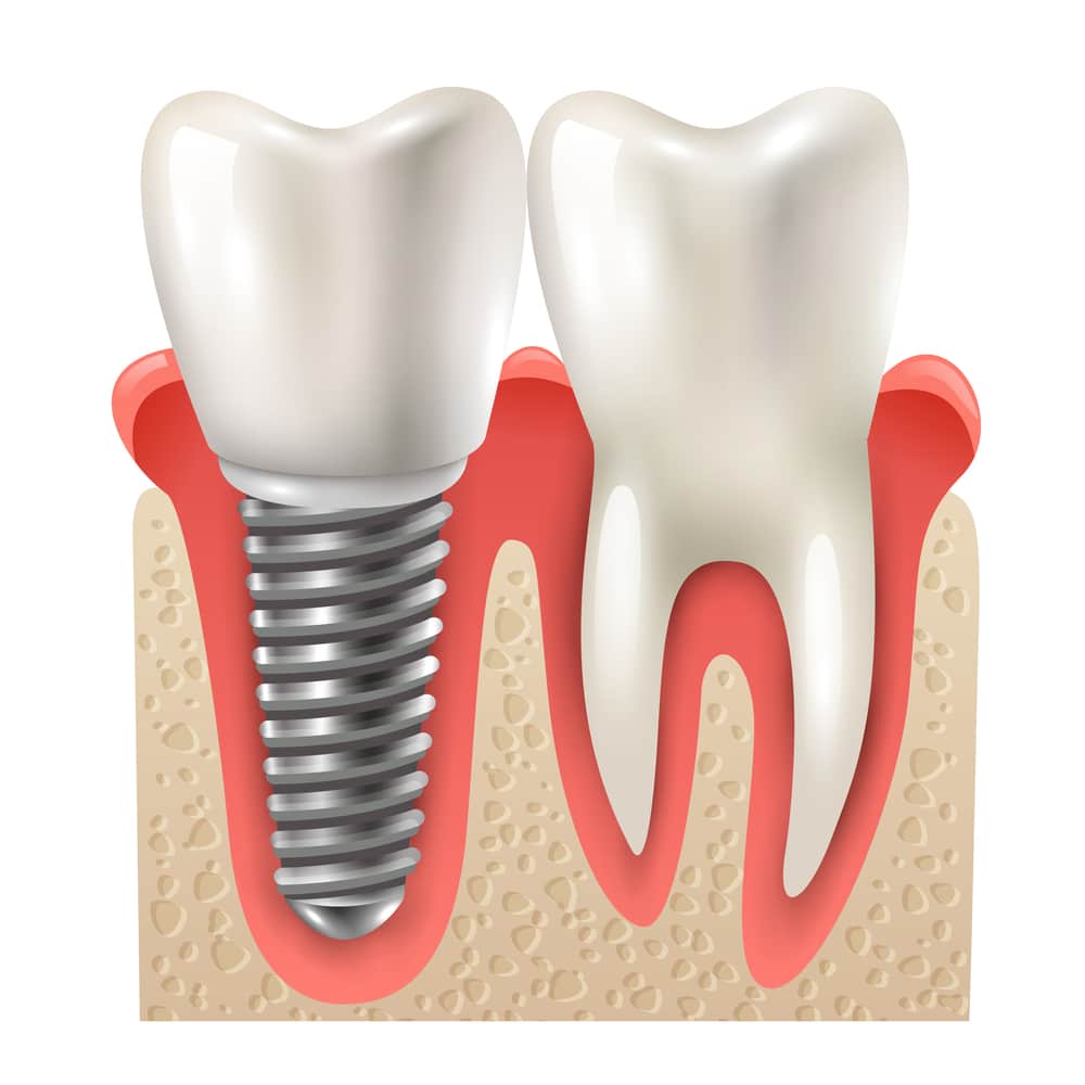 Austin Dentist Explores the Types and Costs of Dental Implants Austin