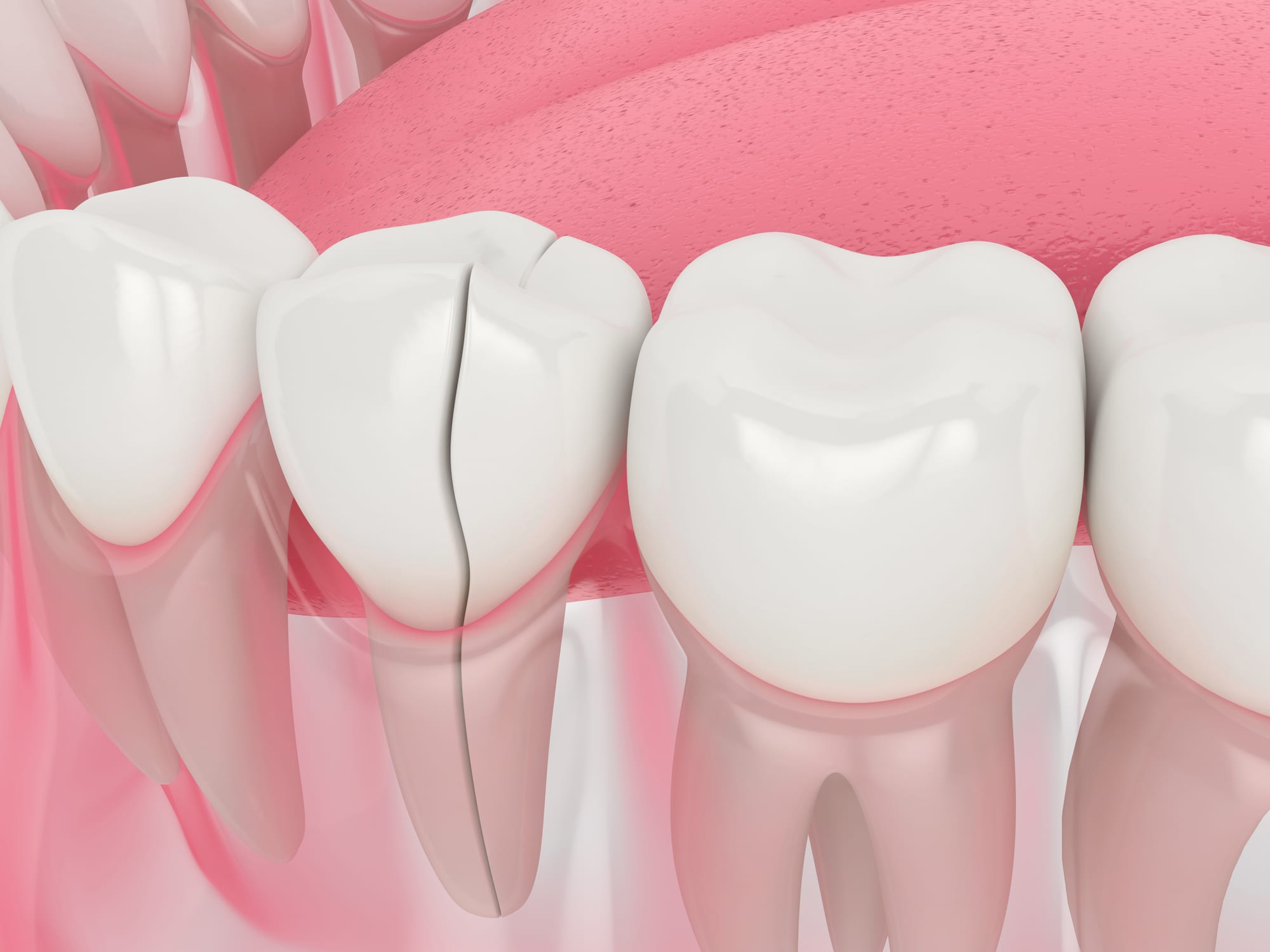 4 Ways to Fix a Cracked Tooth - Austin Laser Dentist - Helen Ragsdale DDS -  Austin Dentist